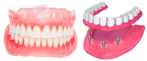 Dentures compared