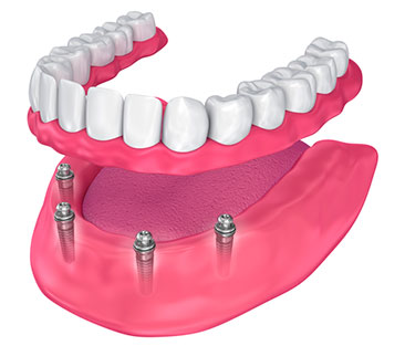 Overdenture